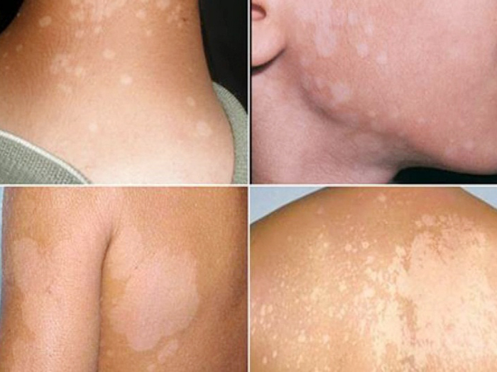 Nam Giới Cùng Những Bệnh Da Liễu Phổ Biến Thường Gặp