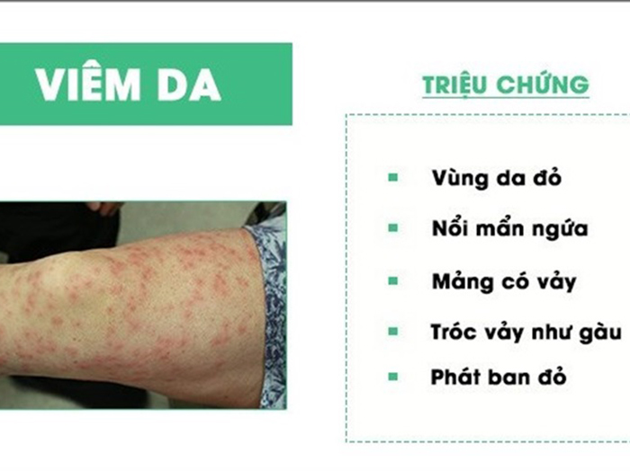 Nam Giới Cùng Những Bệnh Da Liễu Phổ Biến Thường Gặp