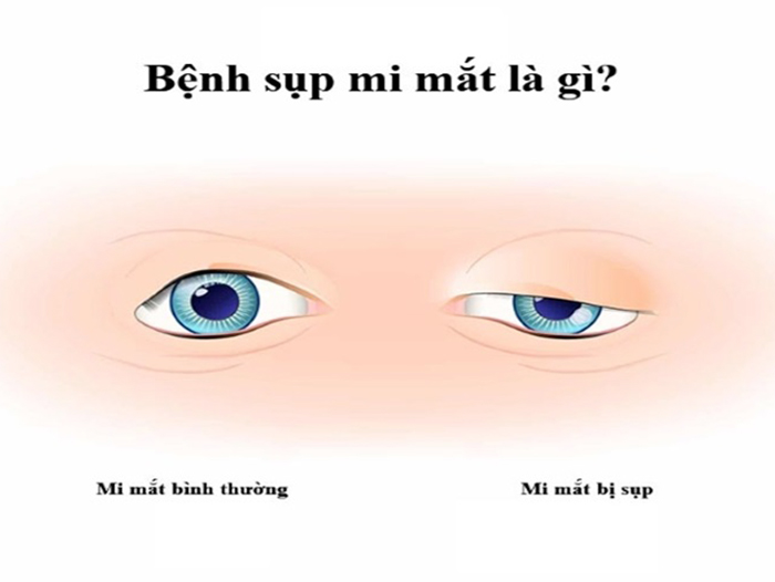 Tổng Hợp Các Bệnh Lý Thường Gặp Về Mắt Của Trẻ Nhỏ