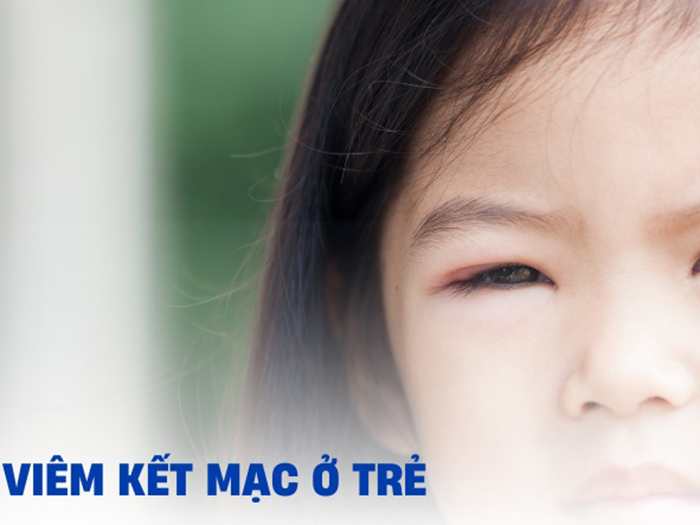 Tổng Hợp Các Bệnh Lý Thường Gặp Về Mắt Của Trẻ Nhỏ