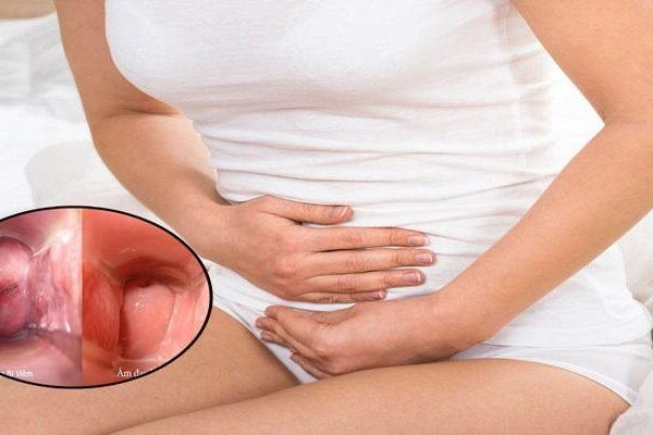 Viêm Nhiễm Phụ Khoa - Nỗi Ám Ảnh Của 90% Phụ Nữ Việt