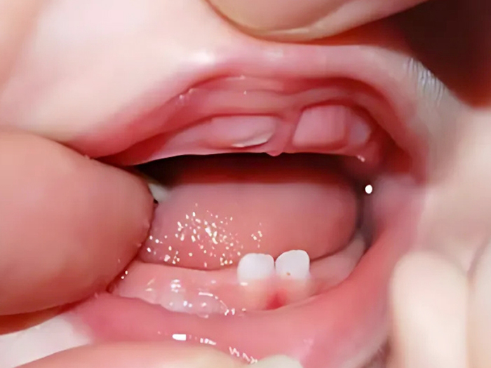 Bạn có biết con mọc răng khi nào? Thứ tự mọc răng ra sao?