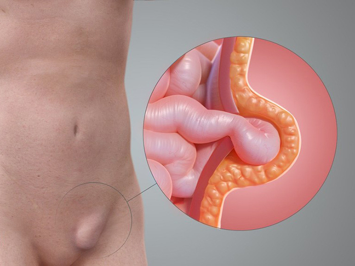 Bệnh thoát vị bẹn tìm hiểu nguyên nhân và cách điều trị