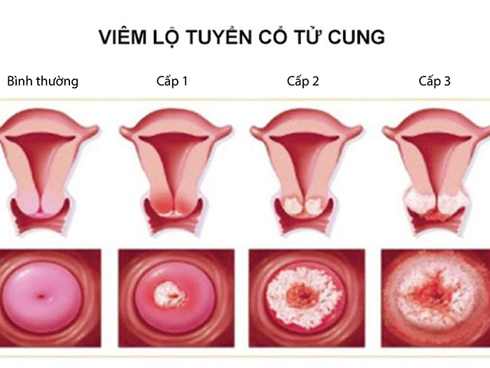 Nguyên nhân bệnh ngứa âm hộ cách phòng ngừa hiệu quả cho chị em