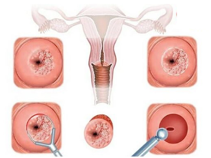 Nguyên nhân, triệu chứng viêm cổ tử cung và cách điều trị.