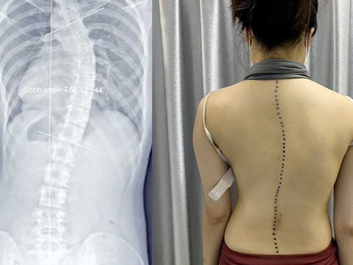 Vẹo cột sống ở trẻ em - Điều trị như thế nào an toàn?