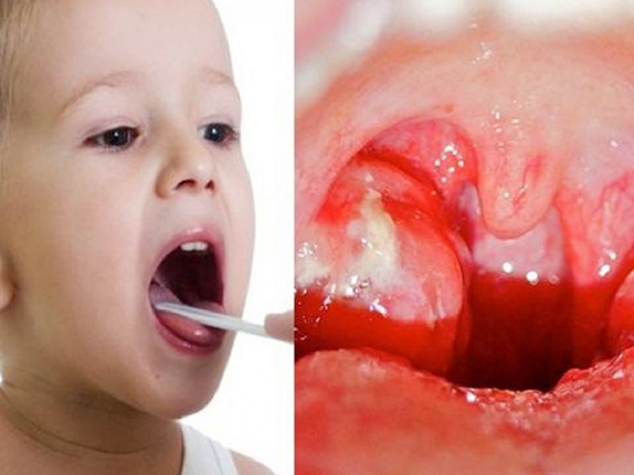 Viêm họng cấp ở trẻ em. Nguyên nhân và cách điều trị an toàn