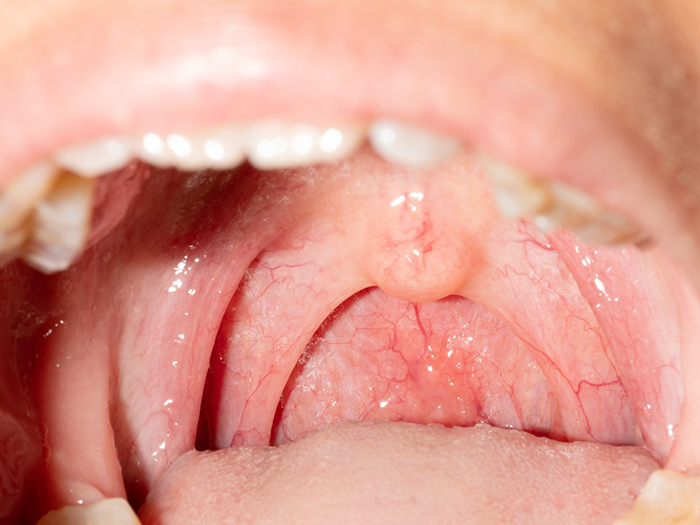 Viêm họng cấp ở trẻ em. Nguyên nhân và cách điều trị an toàn