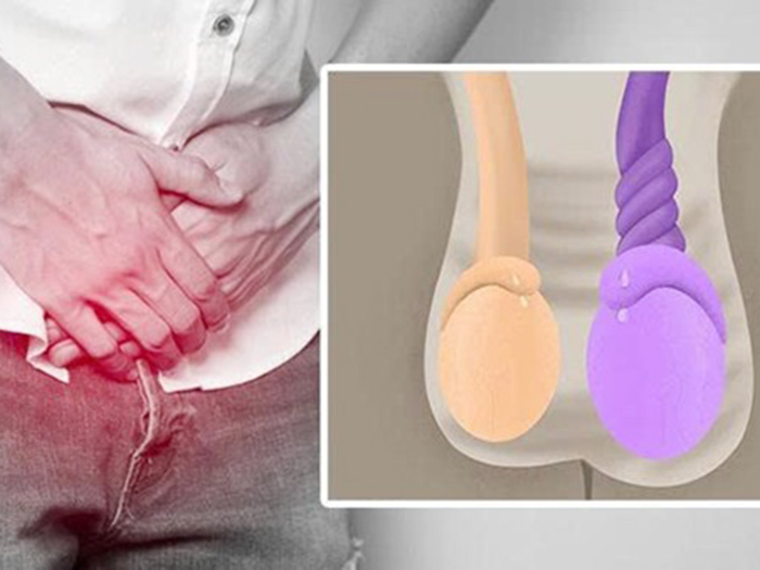 Những thông tin bạn cần biết về bệnh xoắn tinh hoàn?