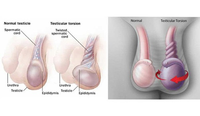 Những thông tin bạn cần biết về bệnh xoắn tinh hoàn?
