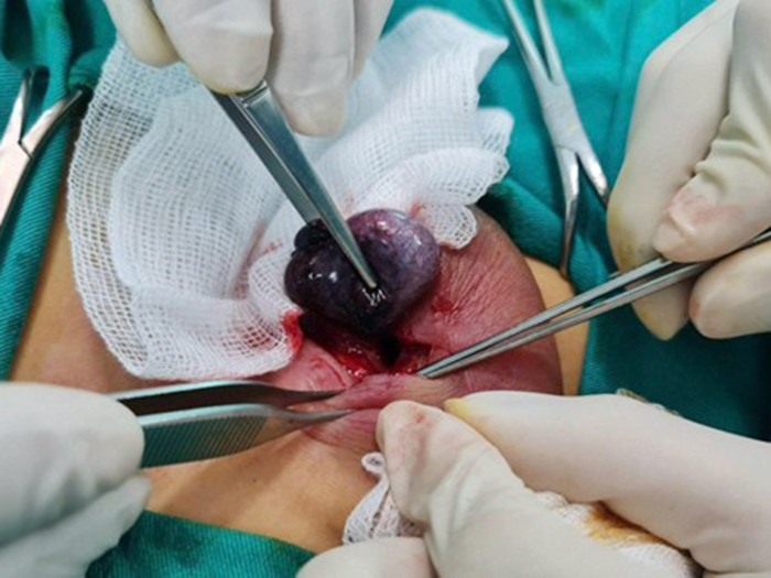 Những thông tin bạn cần biết về bệnh xoắn tinh hoàn?